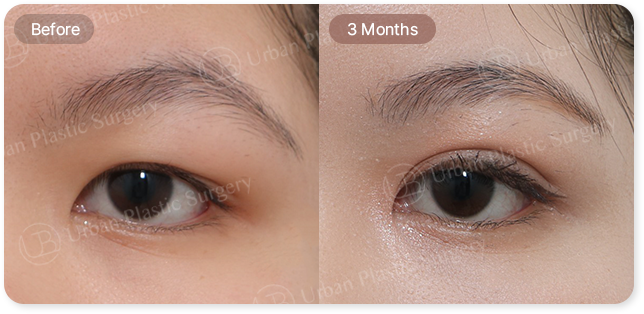 before, 3month