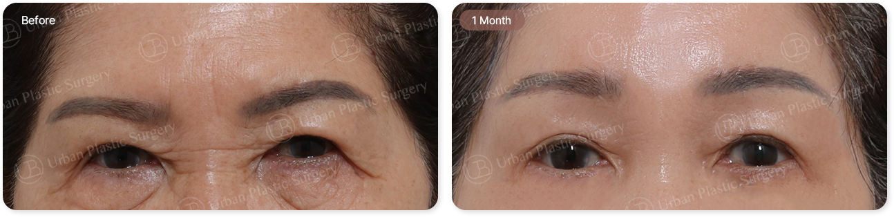 before, 1 month