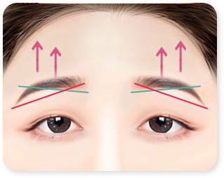 Droopy eyes correction