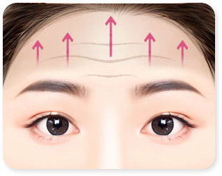 Forehead & glabellar line correction