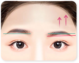 Asymmetrical eyebrow correction