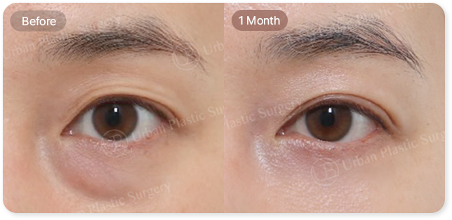 before, 1 month