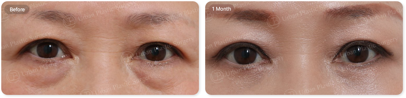 before, 1 month