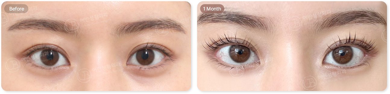 before, 1month