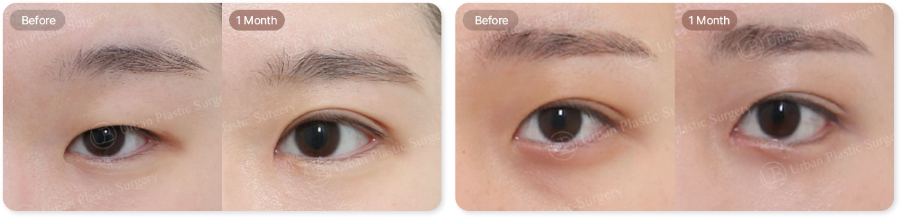 before, 3month