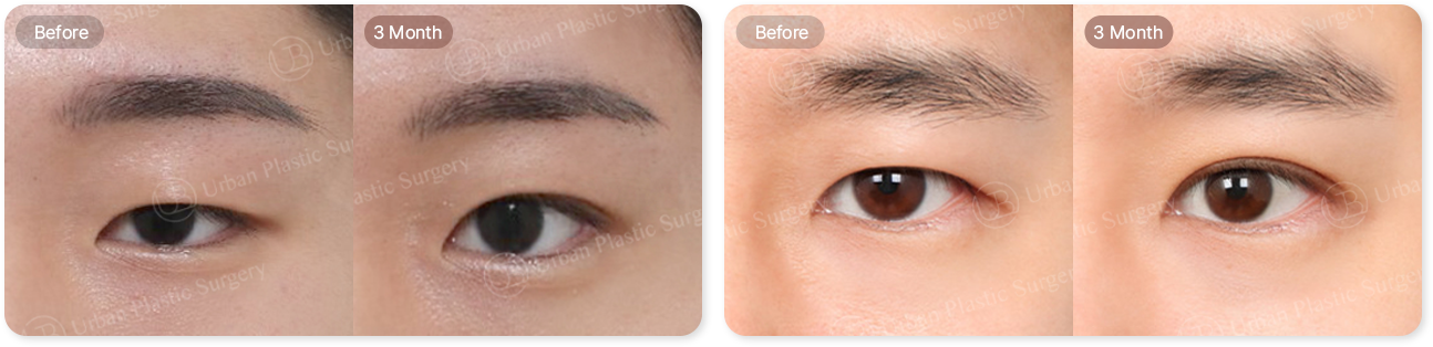 before, 3month