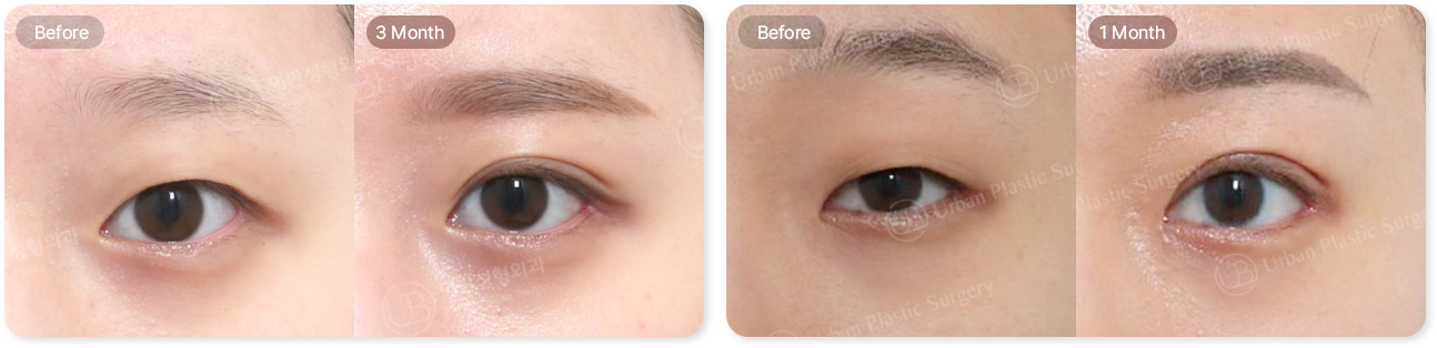 before, 3month