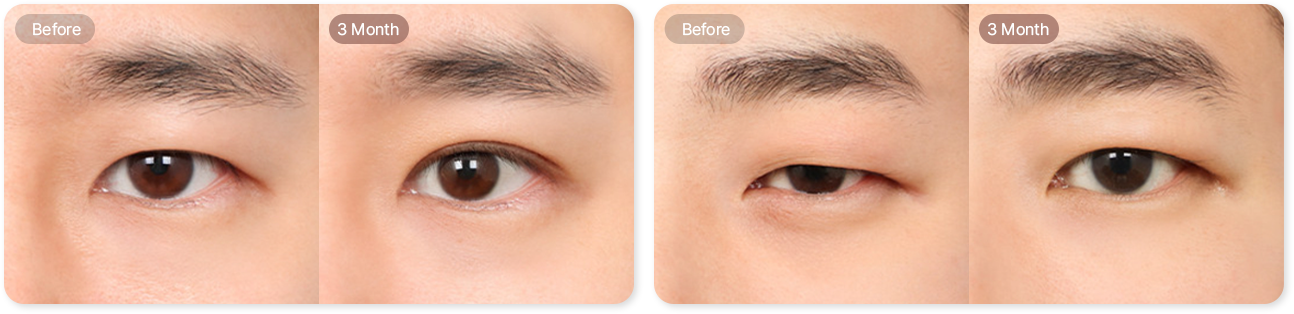 before, 3month