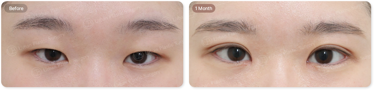 before, 1month