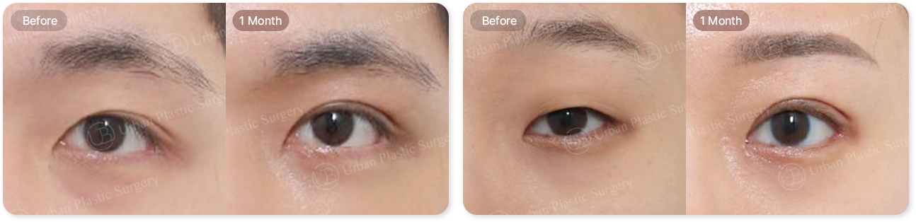 before, 3month