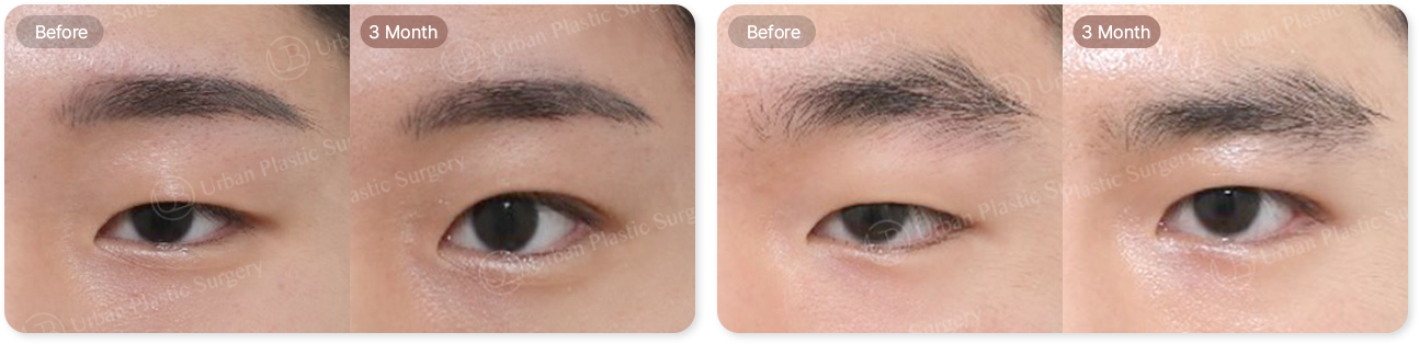 before, 3month