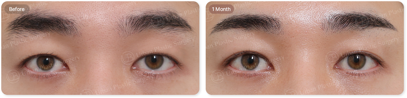 before, 1month