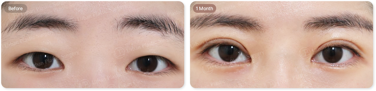 before, 1month