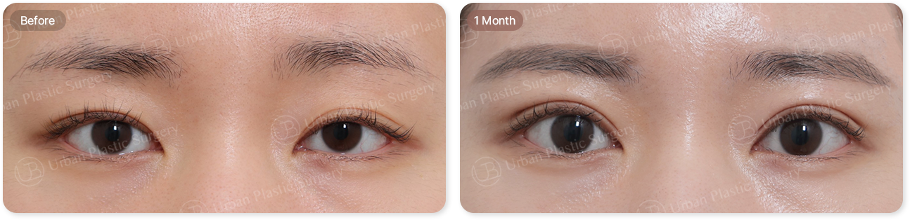 before, 1month