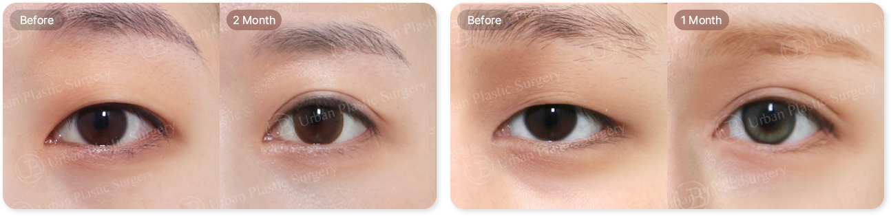 before, 2month, before, 1month