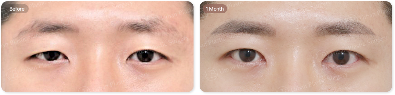 before, 1month
