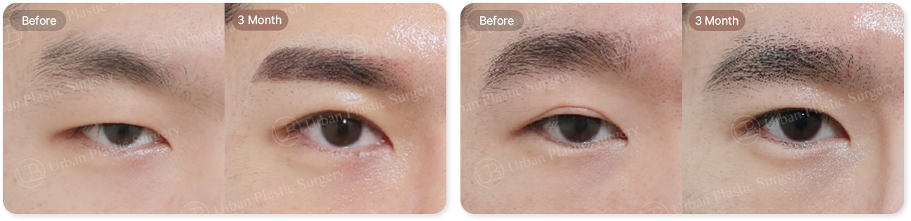 before, 3month