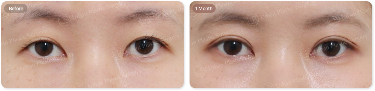before, 1month