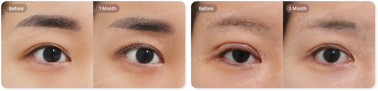 before, 1month, before, 3month