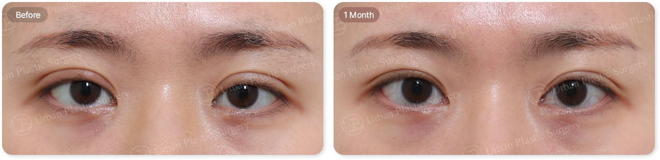 before, 1month
