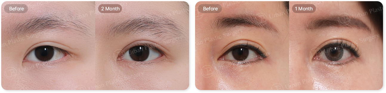 before, 2month, before, 1month
