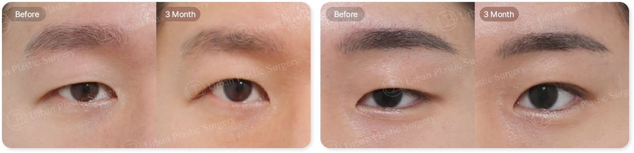 before, 3month