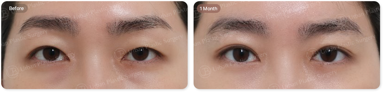 before, 1month