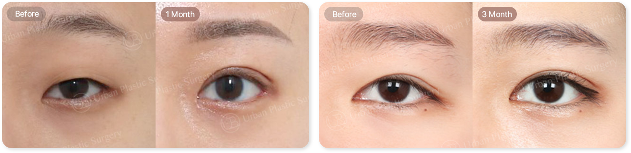 before, 1month, before, 3month