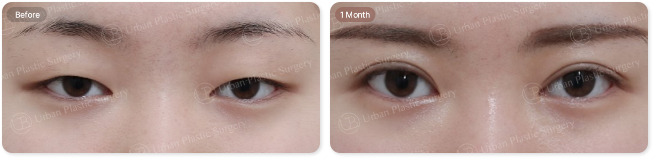 before, 1month