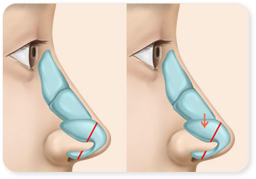 Cartilage reposition