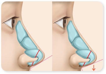 Cartilage reposition + Septal Extension Graft + Rhinoplasty 