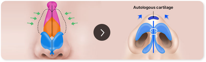 Autologous cartilage